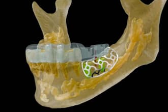 digital implant planning surgical guide design  digital denture cad