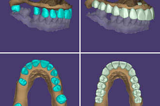 design precise exocad dental crowns, bridges and veneers