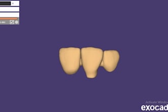 design crown and bridges using exocad