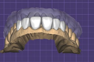 design natural looking dental veneers