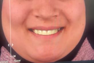 create a digital smile design dsd and dental mockup