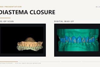design dental crowns, bridges, and implant restorations in exocad