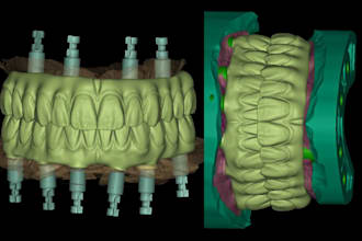 create precise dental cad model on exocad for crowns bridges veneers implants