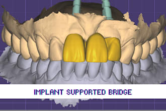 design crowns, bridges, veneers, nightguards, and all on x in exocad