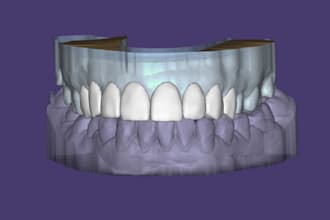design aesthetic dental crown veneers and bridges using exocad