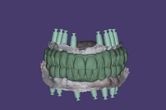 all on x full arch implant prostheses using exocad