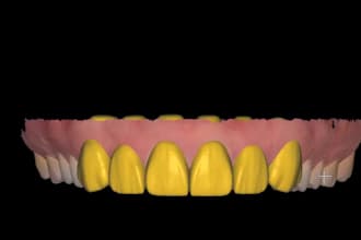 design dental restorations using exocad