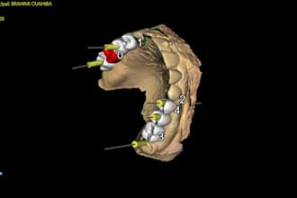 dental implant planning and digital surgical guides using b4d