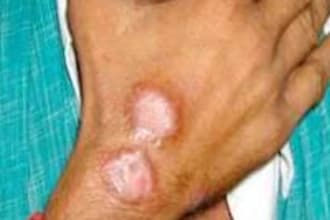 send You Skin Diseases Treatment with Chinese Herb Medicine Recipe