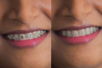 remove braces or whiten teeth