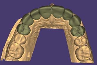 design dental crowns, bridges, implant crowns and partial dentures in exocad