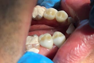 teach you prosthodontics step by step
