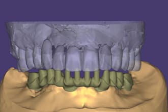design dental crowns and implant crowns in exocad
