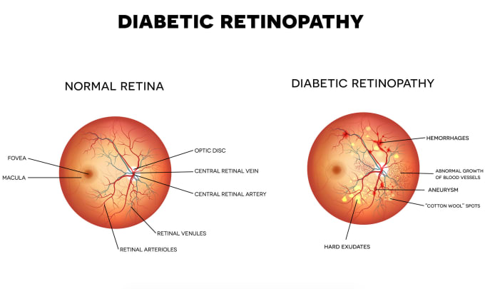 Gig Preview - Provide automated retina disease detection system