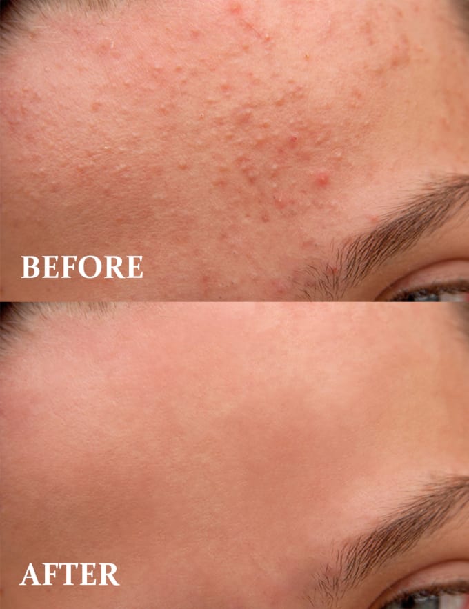 Gig Preview - Remove your acne marks, pimples, dark circles, and eye bags