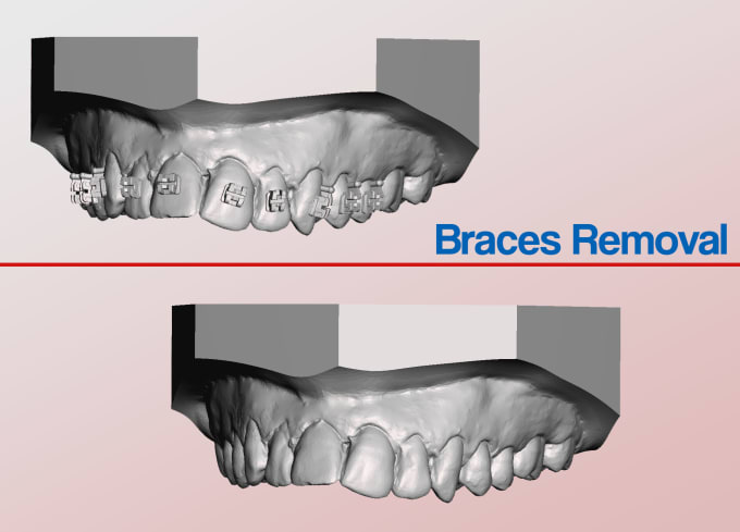 Gig Preview - Do your virtual removal of braces for your orthodontic cases