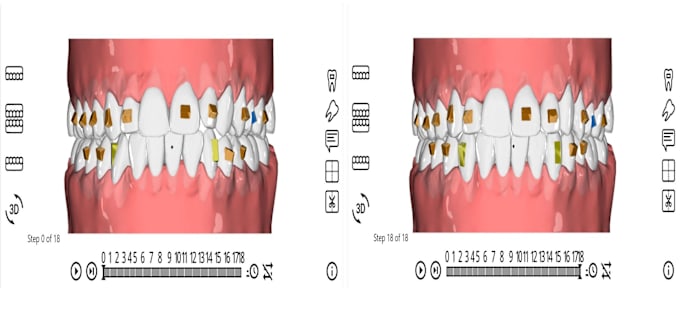 Bestseller - do dental clear aligner treatment planning on onyxceph