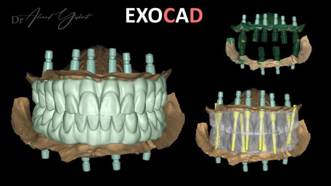 Gig Preview - Screw retained prosthesis crowns, bridges, full arch