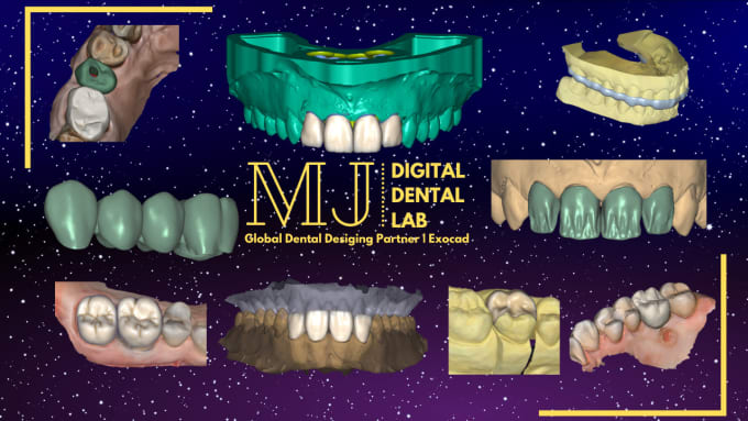 Gig Preview - Design crown and bridge dental cad in exocad