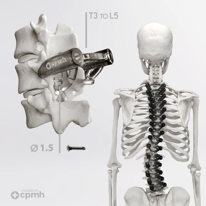 Gig Preview - Do 3d medical modelling, prosthetics and psi implants