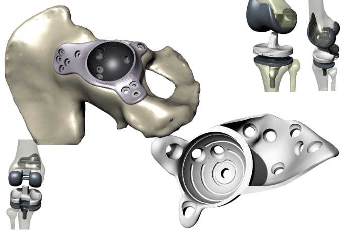 Gig Preview - Create personalized orthopedic implants