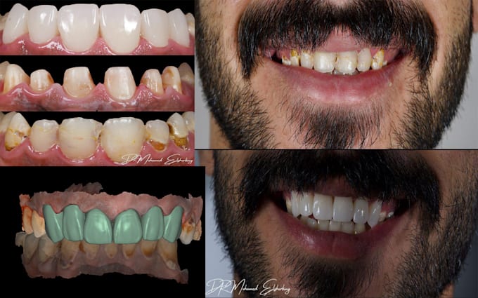 Gig Preview - Make dental designs on exocad crown x bridge  x implant bar