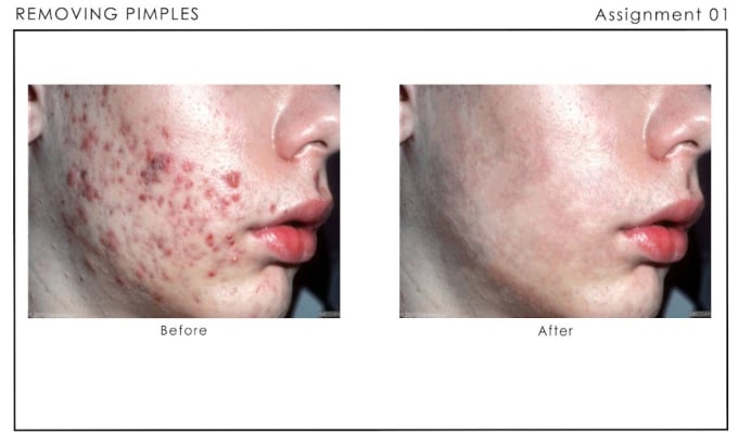 Gig Preview - Clear your acne pictures