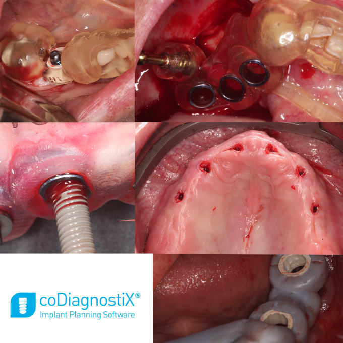 Gig Preview - Create dental implant planning and digital surgical guides using codiagnostix