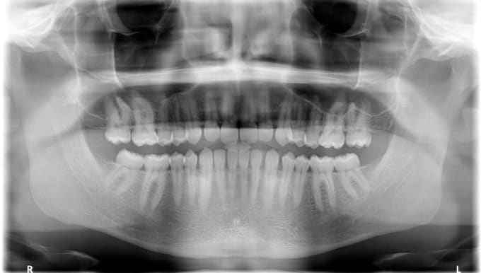 Gig Preview - Comment on your dental xrays