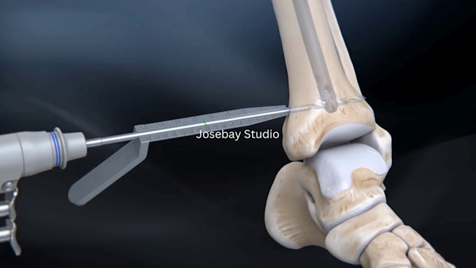 Gig Preview - Do 3d medical animation 3d orthopedic animation medical 3d surgery animation