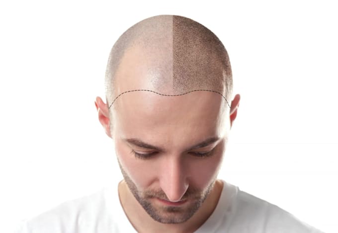 Gig Preview - Monthly SEO service for scalp micropigmentation