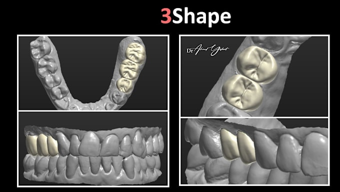 Gig Preview - Design crown, bridge, and wax up using 3shape software