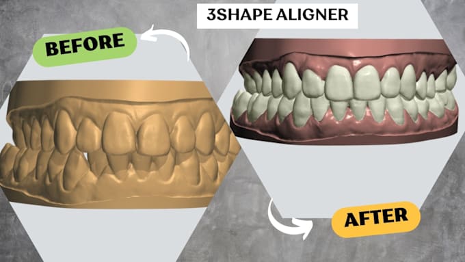 Gig Preview - Your design clear aligner orthodontic case with 3shape ortho