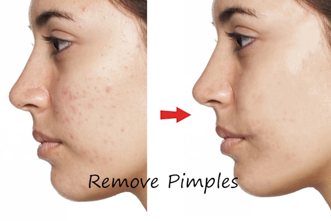 Gig Preview - Remove pimples in your image