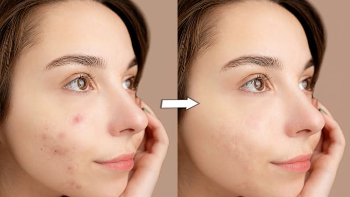 Gig Preview - Retouch your image remove pimples wrinkles acne