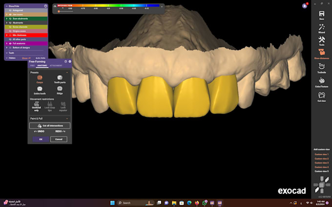 Gig Preview - Make highly aesthatic anterior design using exocad