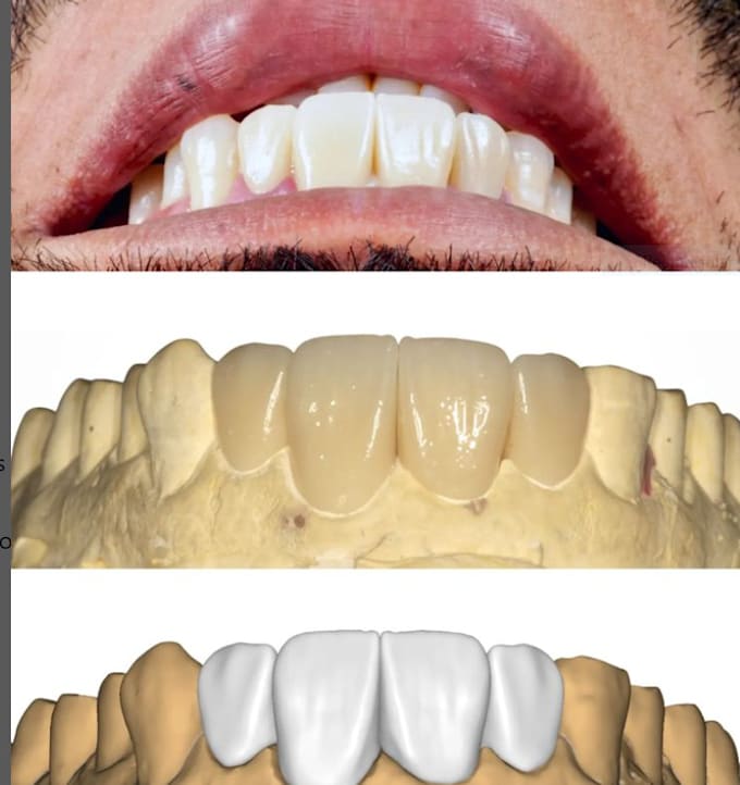 Bestseller - design dental crowns, bridge, implant crown dentures