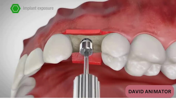 Gig Preview - Create  3d medical animation, 3d surgical, orthodontic dental animation video