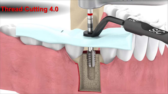 Gig Preview - Create stunning 3d dental animation, medical video, and procedure visual in HD