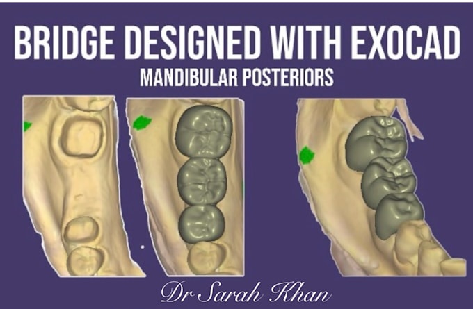 Gig Preview - Design 3d bridge using exocad