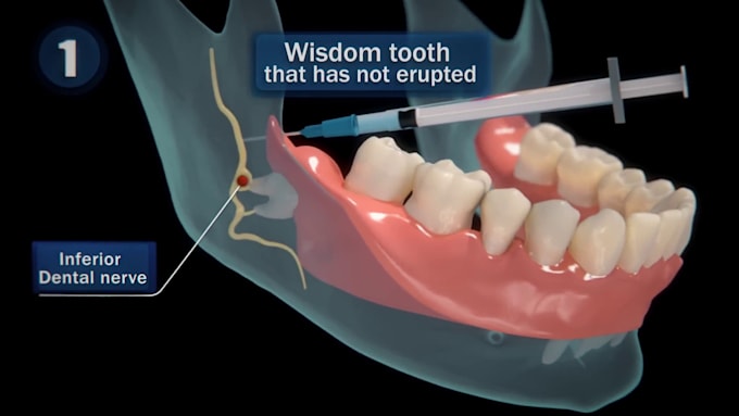 Gig Preview - 3d dental animation 3d medical animation aesthetic wisdom teeth dental animation