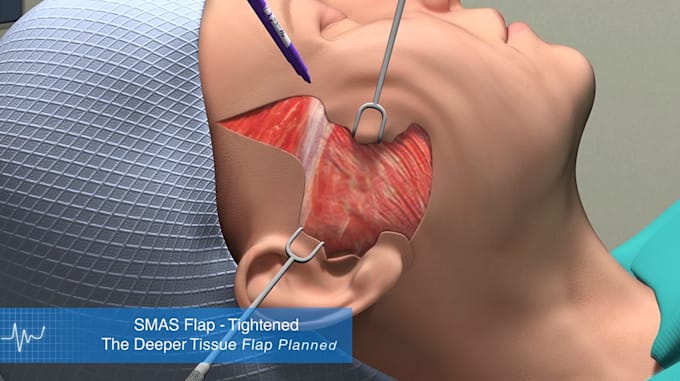 Gig Preview - Do 3d medical animation, surgery animation,3d anatomy animation,dental animation