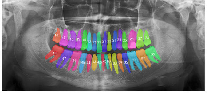 Gig Preview - Annotate dental x rays, fdi numbering and dental mri images