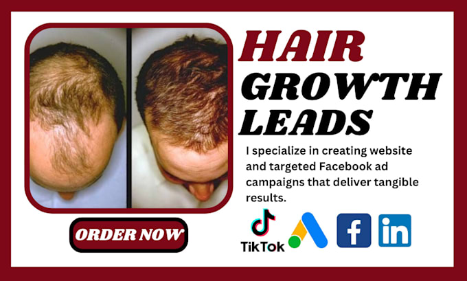 Bestseller - generate hair growth mesotherapy leads hair care leads hair transplant leads