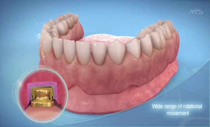 Gig Preview - Create custom 3d dental implant surgery animation procedure animation