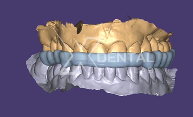 Gig Preview - Bite splint for tmd and bruxism in exocad