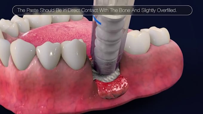 Gig Preview - Offer HD 3d dental animation, 3d medical animation, 3d anatomy, dental animation