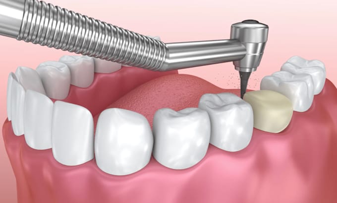 Gig Preview - Create 3d teeth rendering, 3d dental animation, 3d teeth animation, dental video