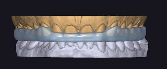 Gig Preview - Design a bite splint in exocad, with canine or anterior guidance