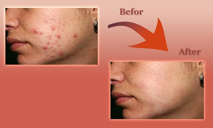 Bestseller - remove the acne from the face in the image